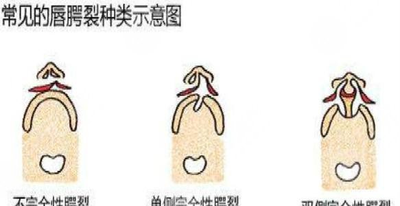 上海唇腭裂手术多少钱