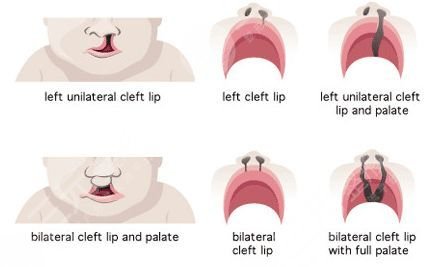 上海唇腭裂手术多少钱