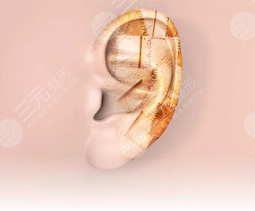 耳再造直埋法耳后疤痕