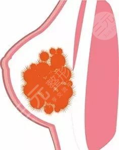 奥美定取出后可以马上做假体吗