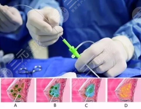 奥美定取出后可以马上做假体吗