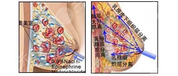 奥美定取出后可以马上做假体吗
