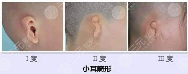 耳再造多少费用