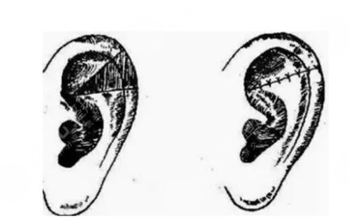 耳再造多少费用