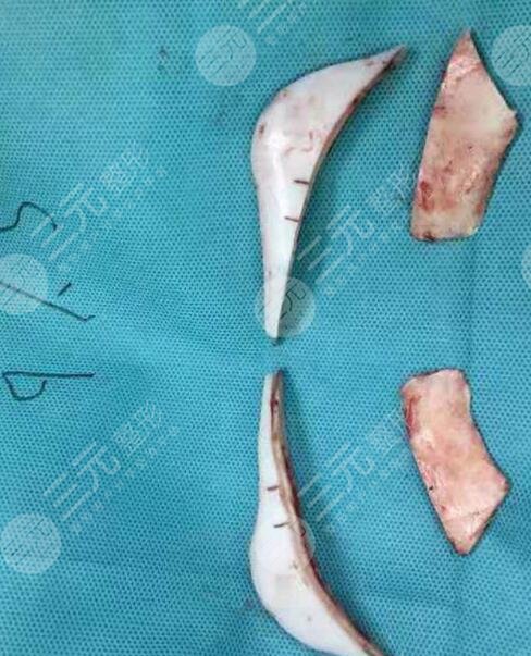 磨下颌骨手术术前注意事项介绍