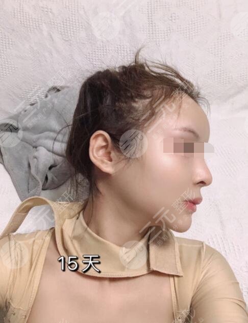 磨下颌骨手术术后