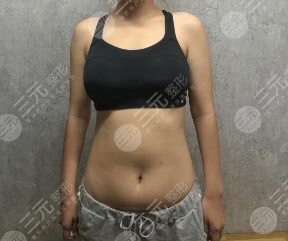 水动力吸脂手术前