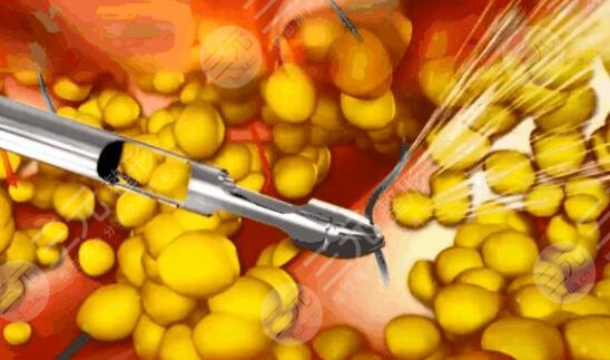 黄金微雕吸脂和普通吸脂的区别是啥？2者之间应该怎么选呢？