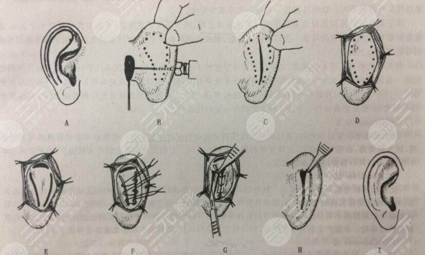 颅耳角在30°-60°之间是一种天生畸形，矫正方法如下