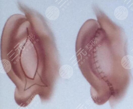 颅耳角在30°-60°之间整形矫正