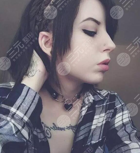 颅耳角在30°-60°之间整形