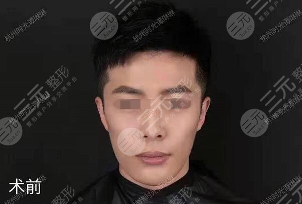 网红圈都在做的颅耳角在30°-60°之间整形前