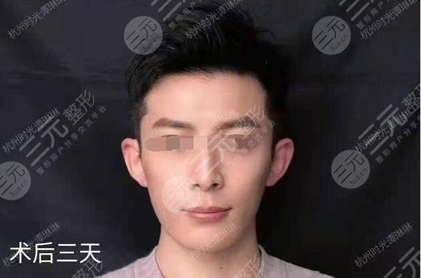 网红圈都在做的颅耳角在30°-60°之间整形后