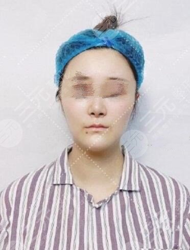 颅耳角在30°-60°之间整形前