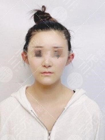 颅耳角在30°-60°之间整形后