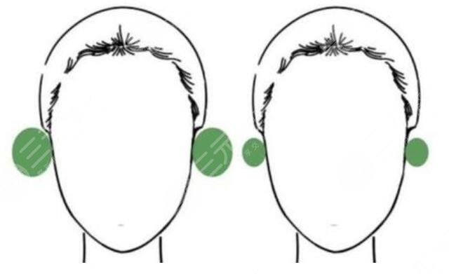 先天性颅耳角在30°-60°之间矫正多少钱