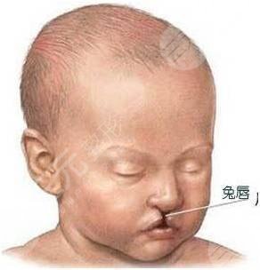 唇腭裂能完全修复好吗？“兔宝宝”的修复指南分享！