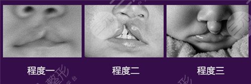 唇腭裂能完全修复好吗