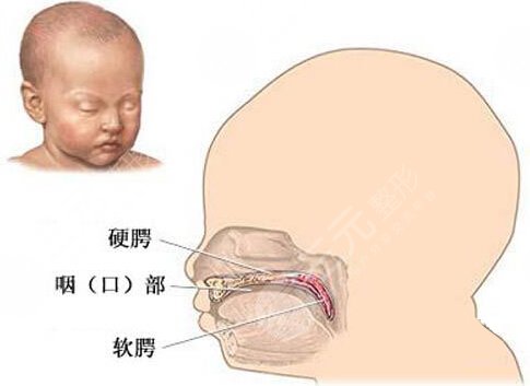 唇腭裂能完全修复好吗