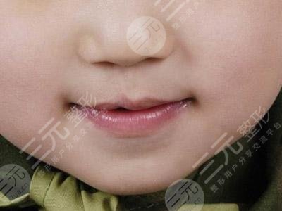 唇腭裂能完全修复好吗