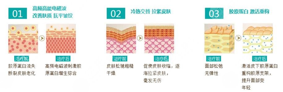 美容项目热玛吉价格多少