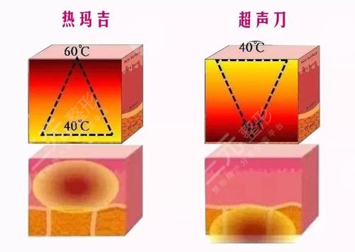美容项目热玛吉价格多少