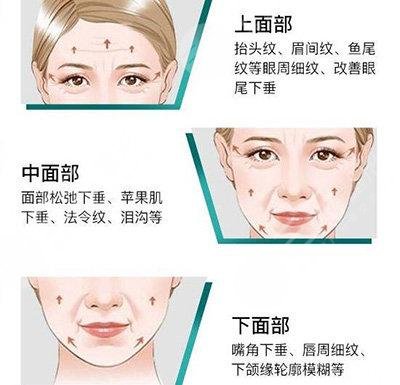 热玛吉成好吗能保持多久