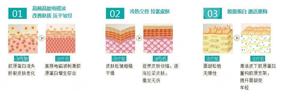 热玛吉成好吗能保持多久