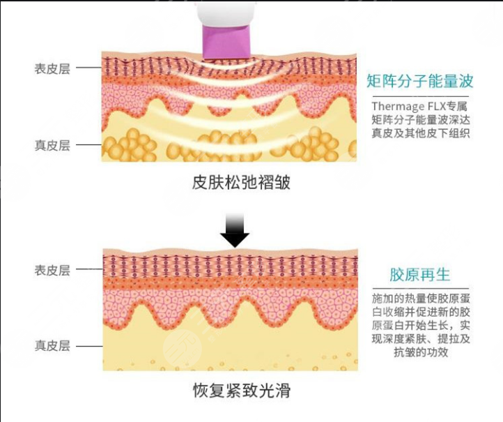 做热玛吉的后遗症