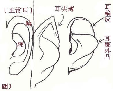颅耳角在30°-60°之间朵怎么整形