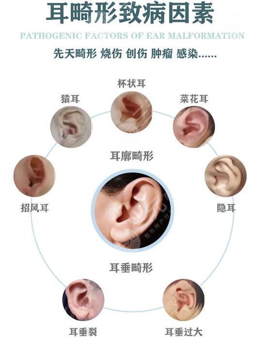 颅耳角在30°-60°之间朵形成原因