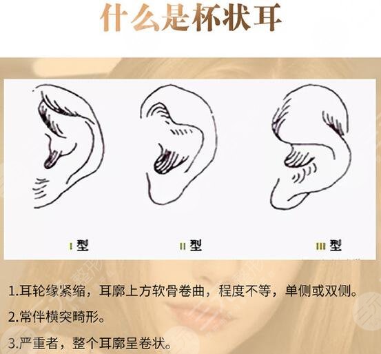 杯状耳矫正年龄多大合适？手术科普&术后护理知识超全干货！