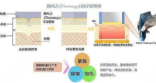 热玛吉去皱成好吗