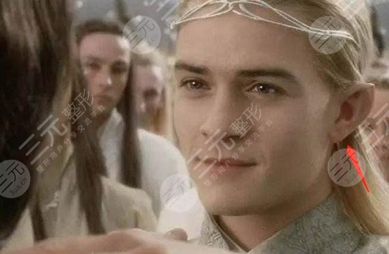 颅耳角在30°-60°之间朵怎么整形