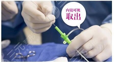 奥美定取出后残留还会致癌吗