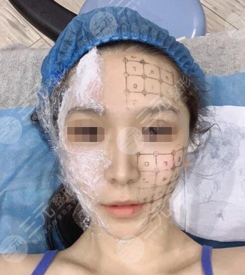 热玛吉的缓解果