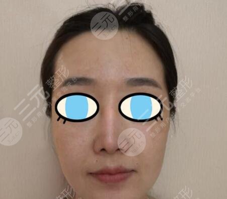 热玛吉术前
