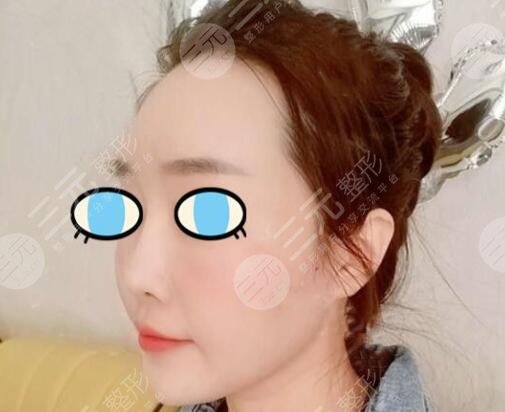 热玛吉术后