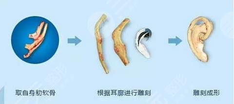 国内耳再造费用