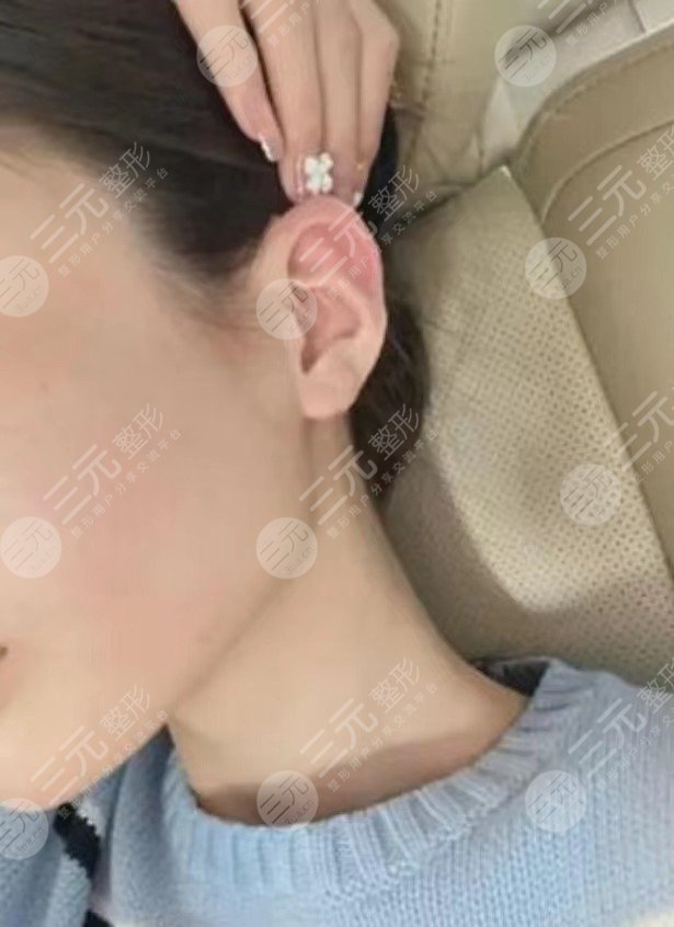 贴发耳矫正手术大概多少钱