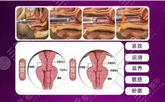 欧洲之星fotona私密几种探头怎么选择?超全科普让你领略性福!