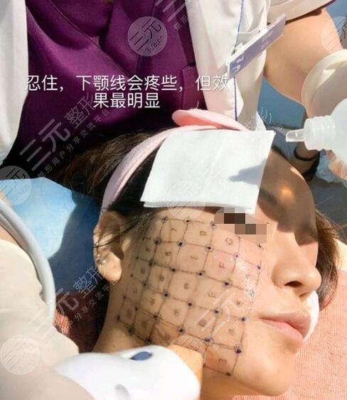 做热玛吉痛不痛