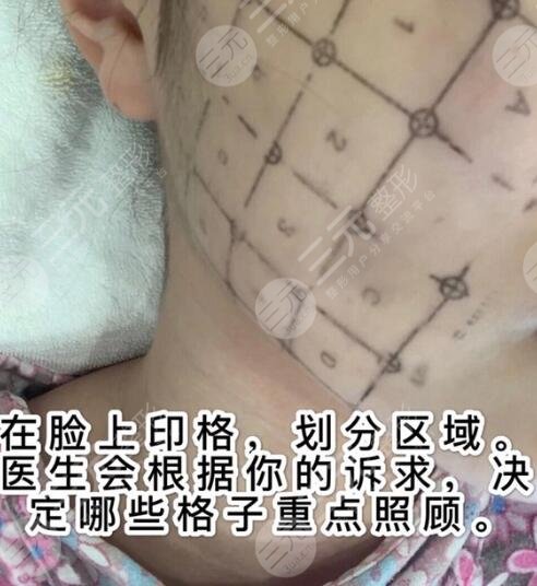 做热玛吉会不会很痛呢