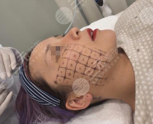 热玛吉操作中