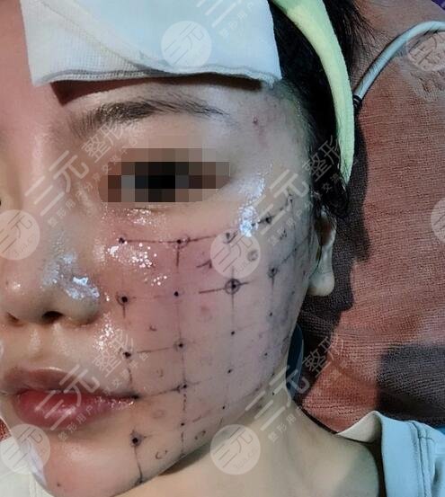 做热玛吉的副作用