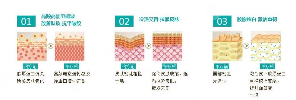 北京三甲医院热玛吉一次多少钱