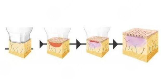 北京五代热玛吉的多少钱