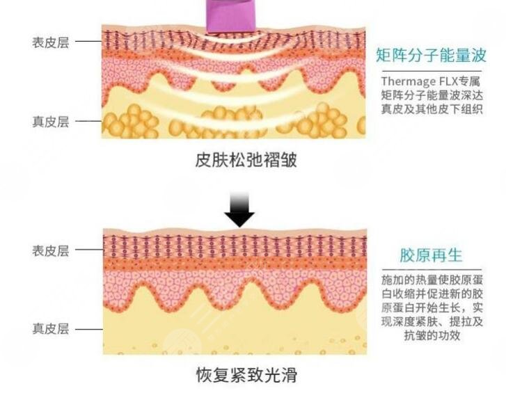武汉做一个热玛吉多少钱
