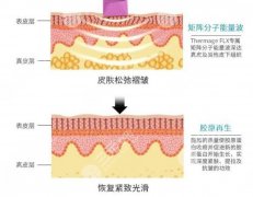 武汉热玛吉术后注意事项分享!7个重点,超贴心攻略宝典! 武汉热玛吉术后注意事项分享!7个重点,超贴心攻略宝典!