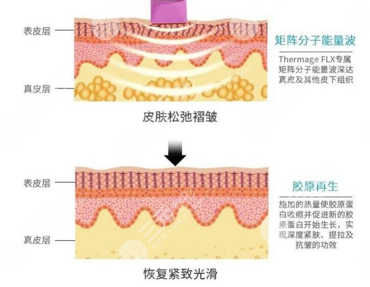 武汉热玛吉术后注意事项